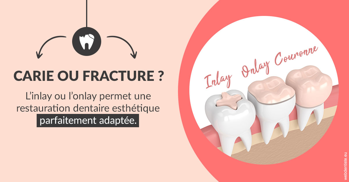 https://selarl-geyselinck.chirurgiens-dentistes.fr/T2 2023 - Carie ou fracture 2