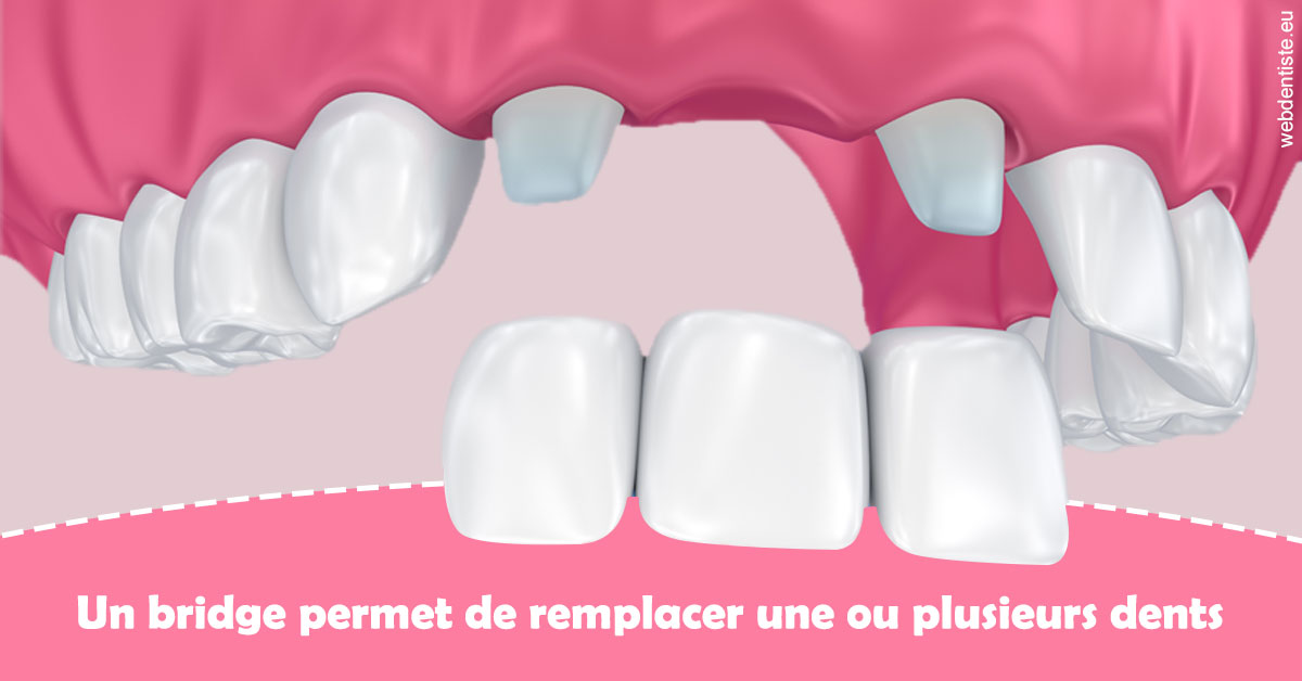 https://selarl-geyselinck.chirurgiens-dentistes.fr/Bridge remplacer dents 2