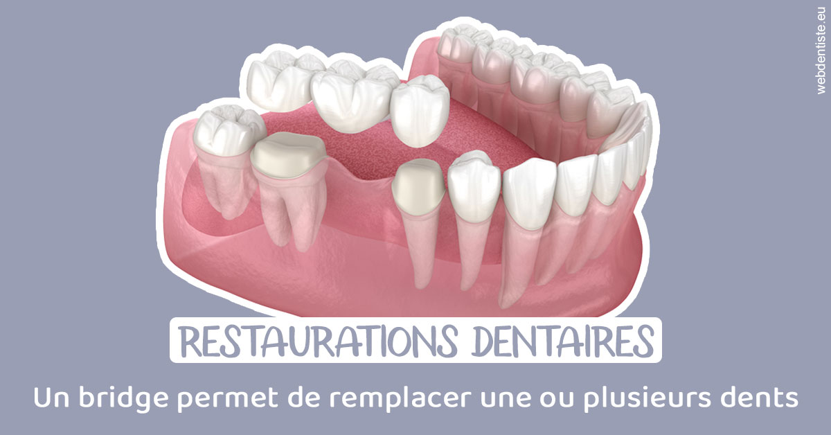 https://selarl-geyselinck.chirurgiens-dentistes.fr/Bridge remplacer dents 1