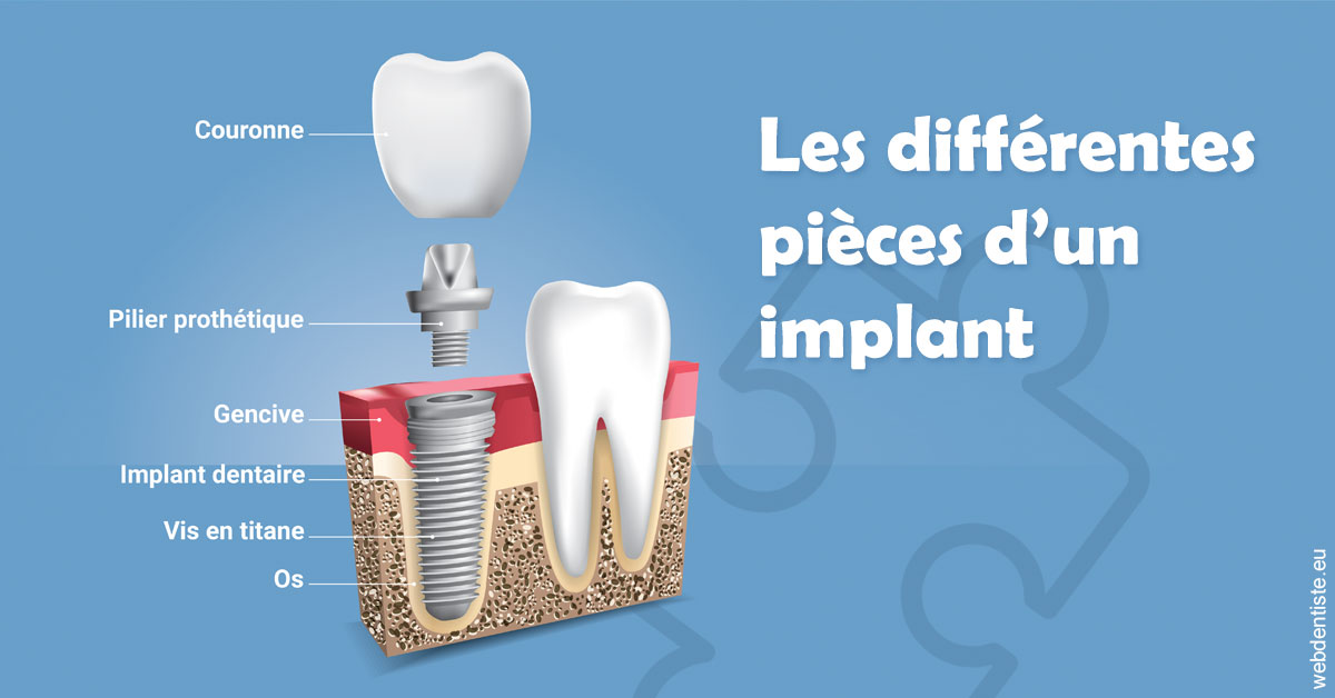 https://selarl-geyselinck.chirurgiens-dentistes.fr/Les différentes pièces d’un implant 1